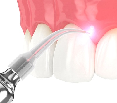 Illustration of soft tissue laser being used on gums