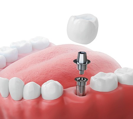 Digital image of dental implant and its parts